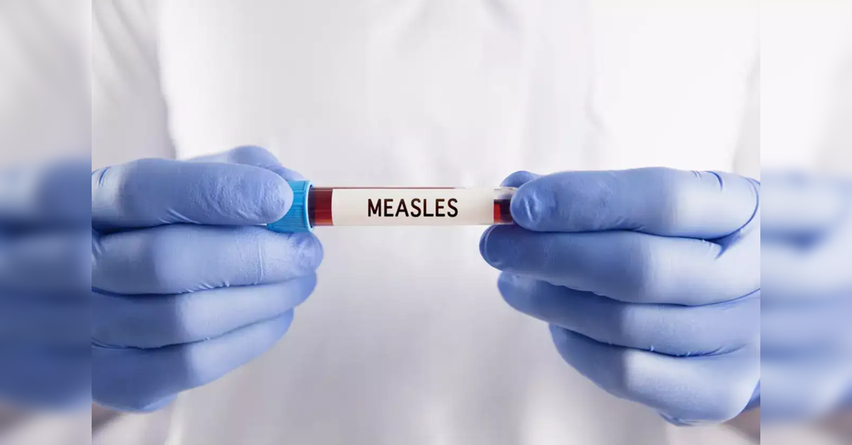 Measles cases in US reach all-time high after disease was declared 'eliminated': Check symptoms and prevention tips