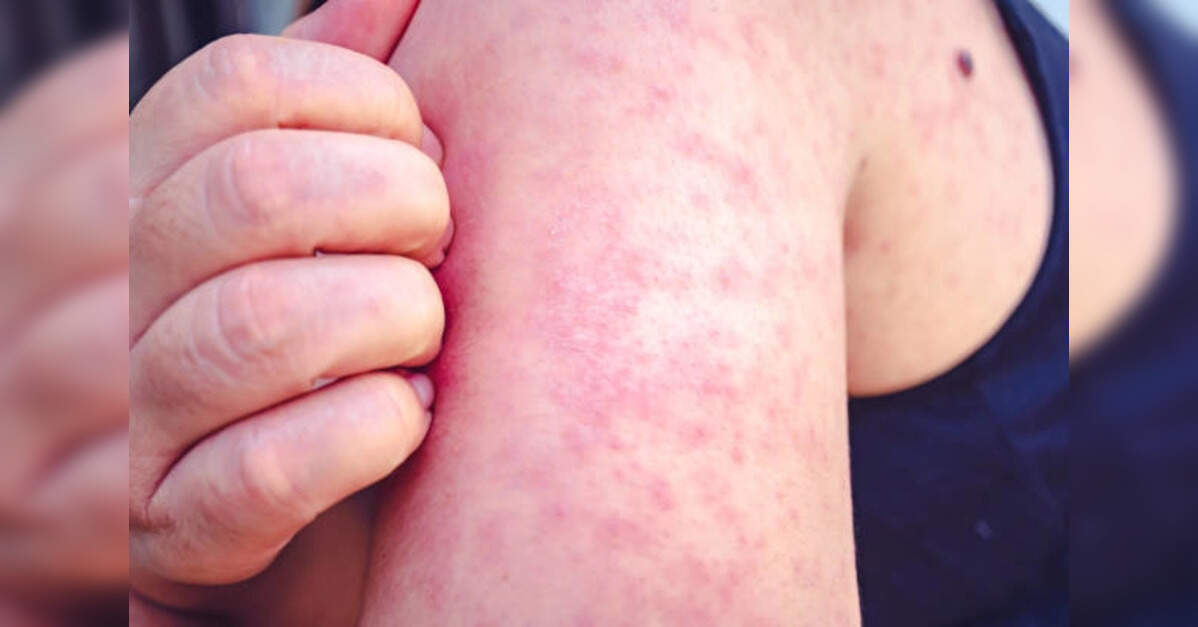 South Carolina measles cases rise to 646, Clemson exposure widens outbreak risk, ETHealthworld