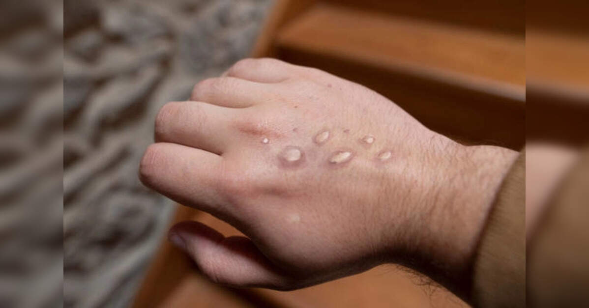 Monkey pox strain links Kerala cases to foreign travel: Study