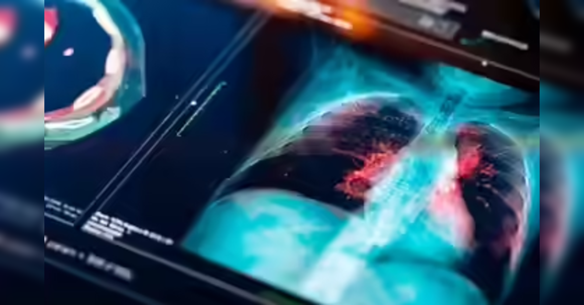 India carries Asia’s heaviest lung disease burden, Lancet study finds