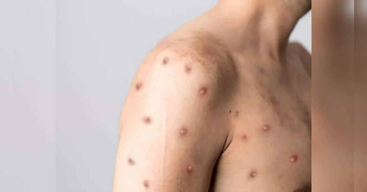 TN ups surveillance as chickenpox cases rise among children
