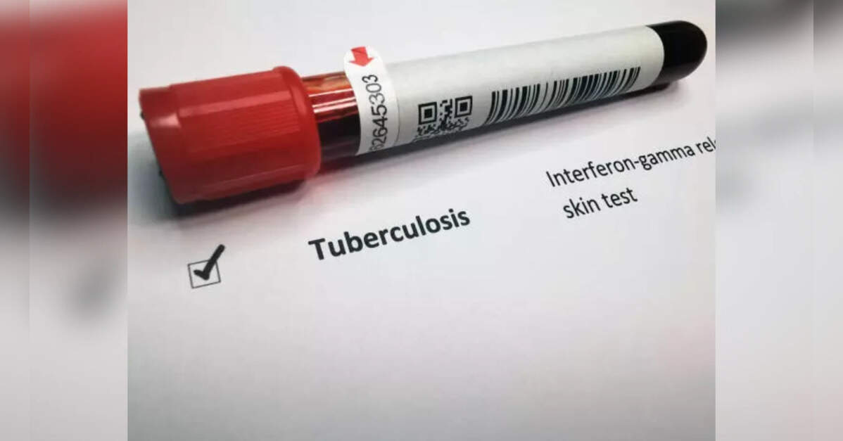 Doctors call for sustained action to eradicate TB; warn of impact on fertility, overall health