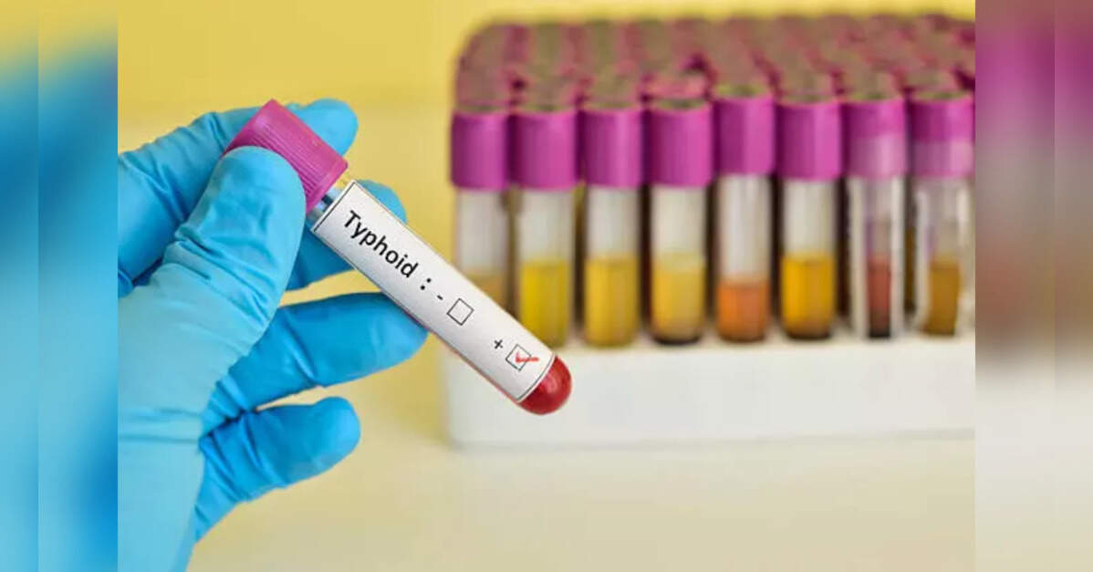 Antibiotic resistance fuels 87% of India’s typhoid economic burden: Study