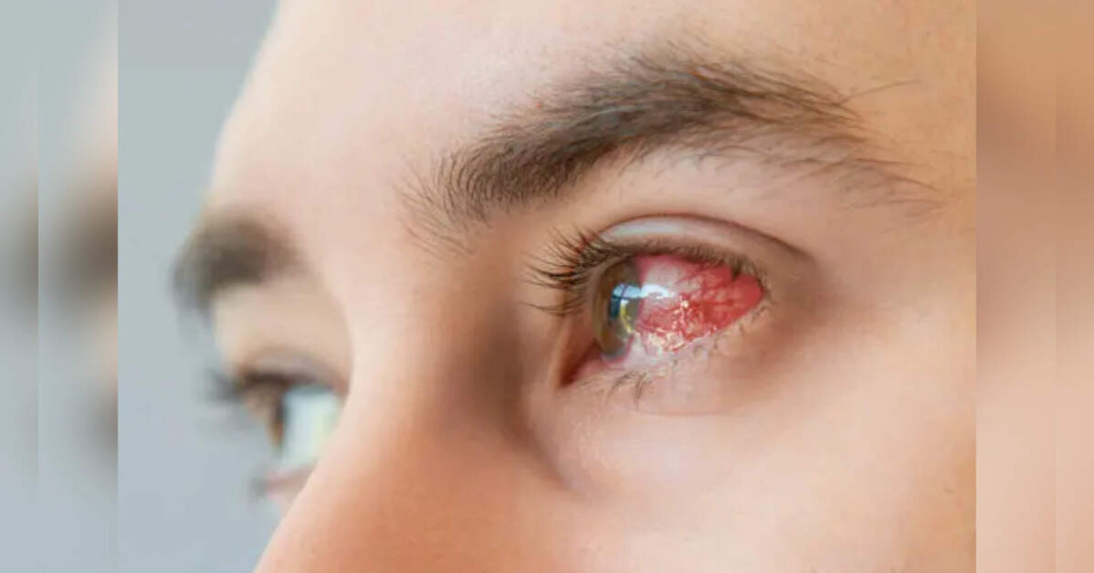 Over 45% eye infection bacteria drug-resistant, study flags AMR threat
