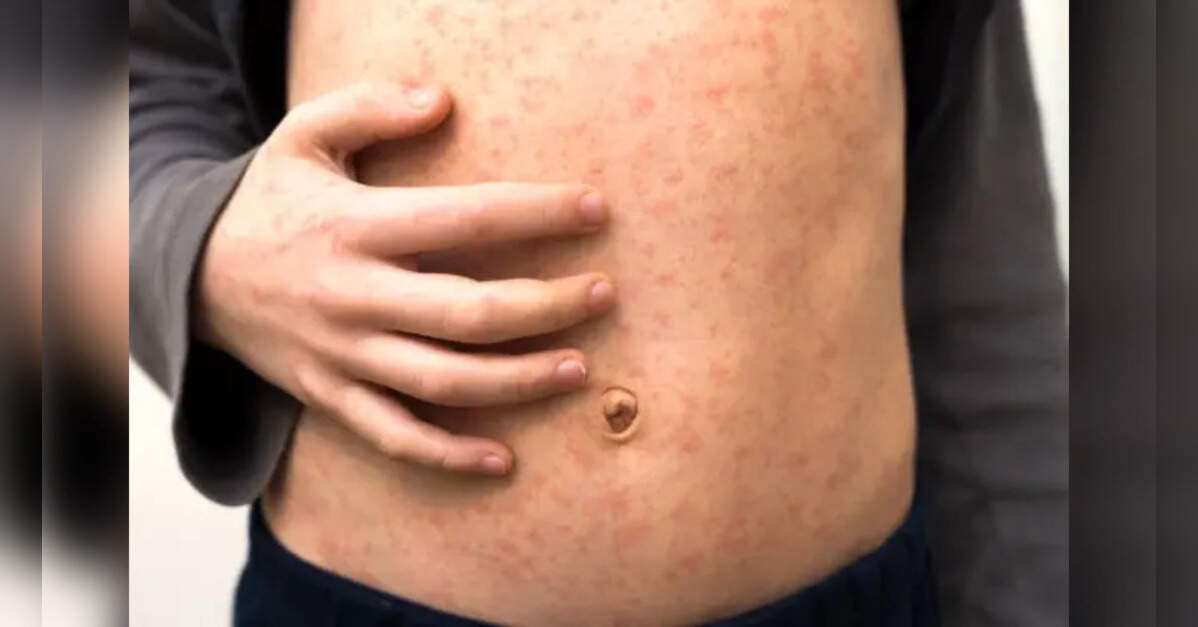 Vaccine gaps fuel Bangladesh's deadly measles crisis