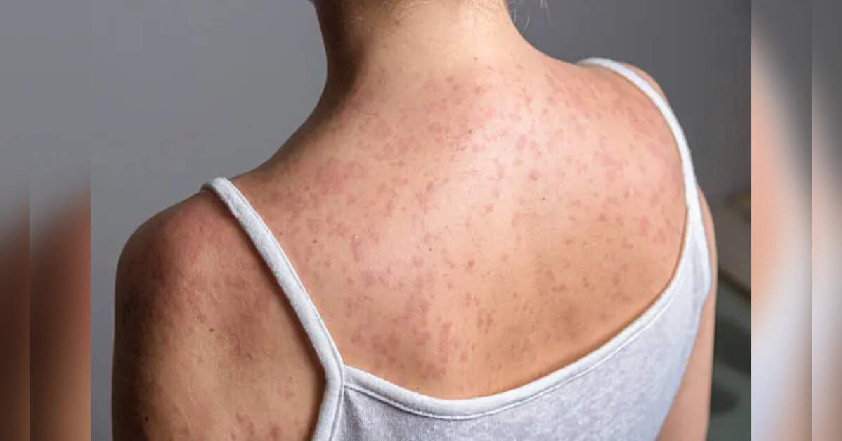 South Carolina declares end to measles outbreak after nearly 1,000 cases