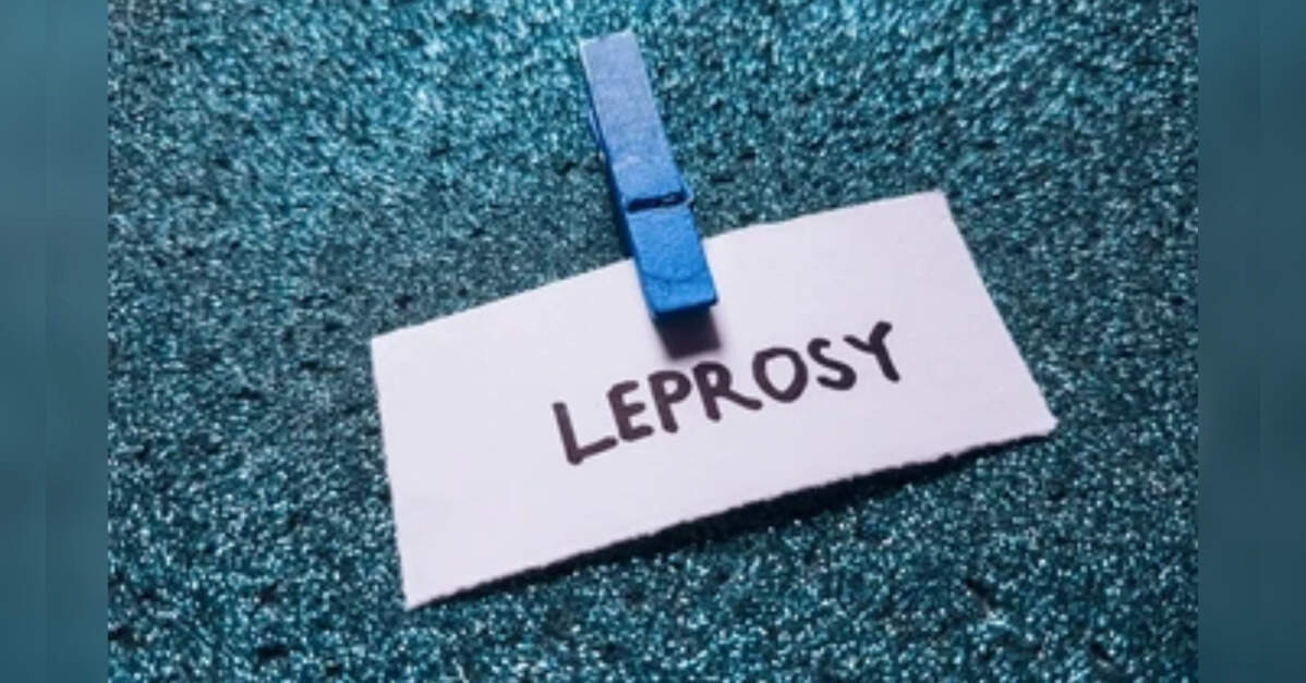 Delhi to declare Leprosy a notifiable disease under the Delhi Epidemic Diseases Act