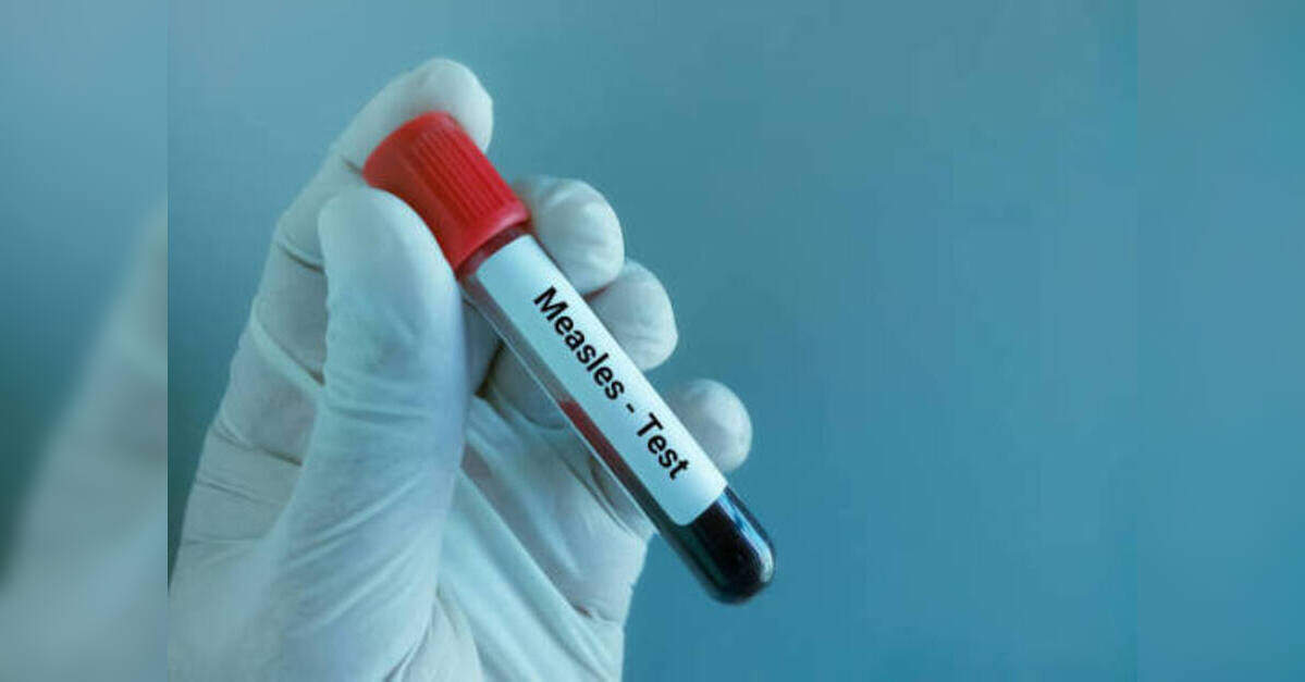 No New Measles Cases in Balaghat, MP for a Week, ETHealthworld