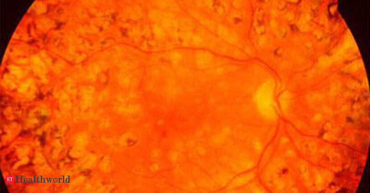 Now, screen your babies for retinopathy of prematurity (RoP) at Namakkal government hospital