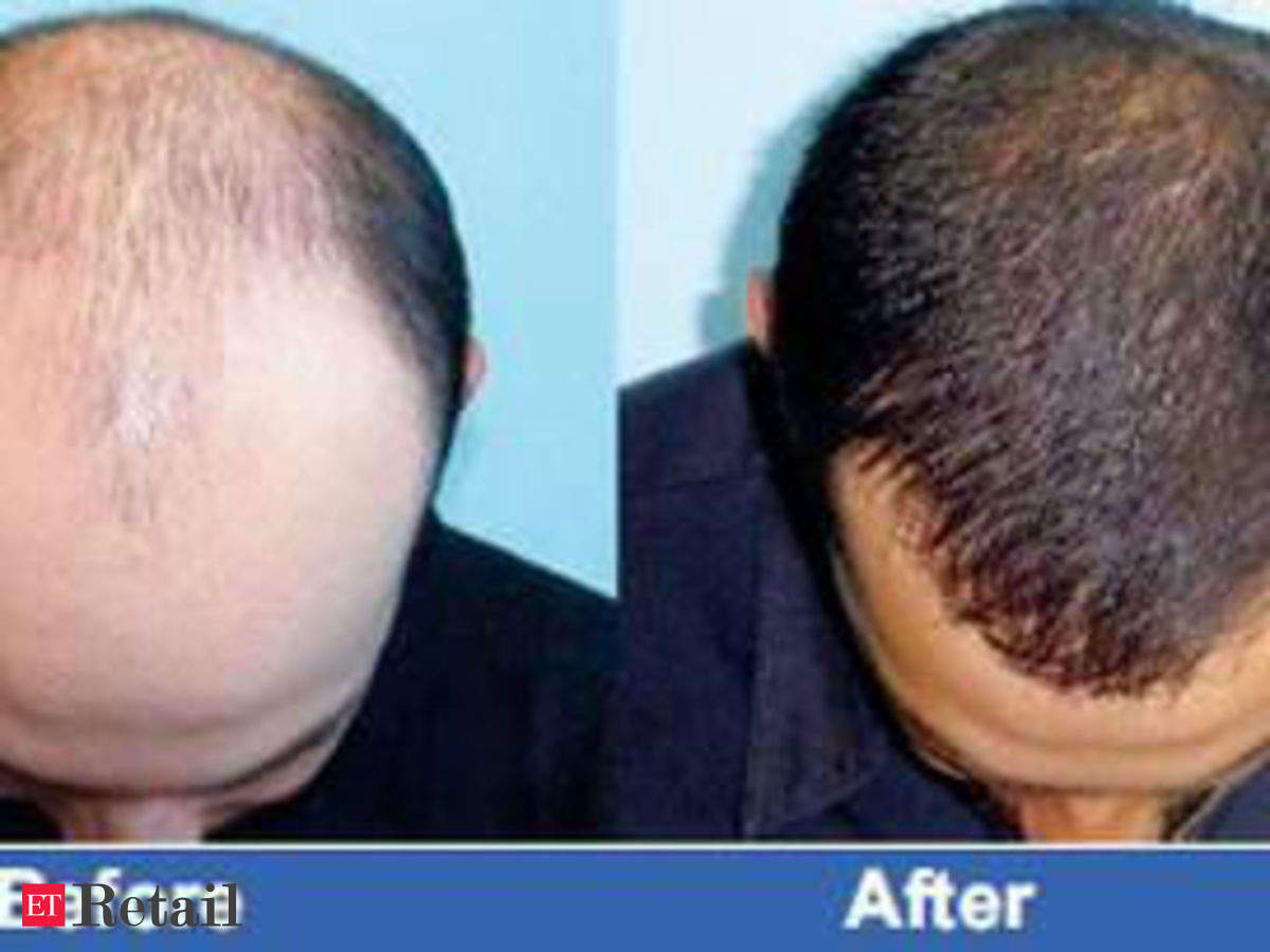 DHI tops consumer satisfaction in hair transplant services: IMRB, Retail  News, ET Retail