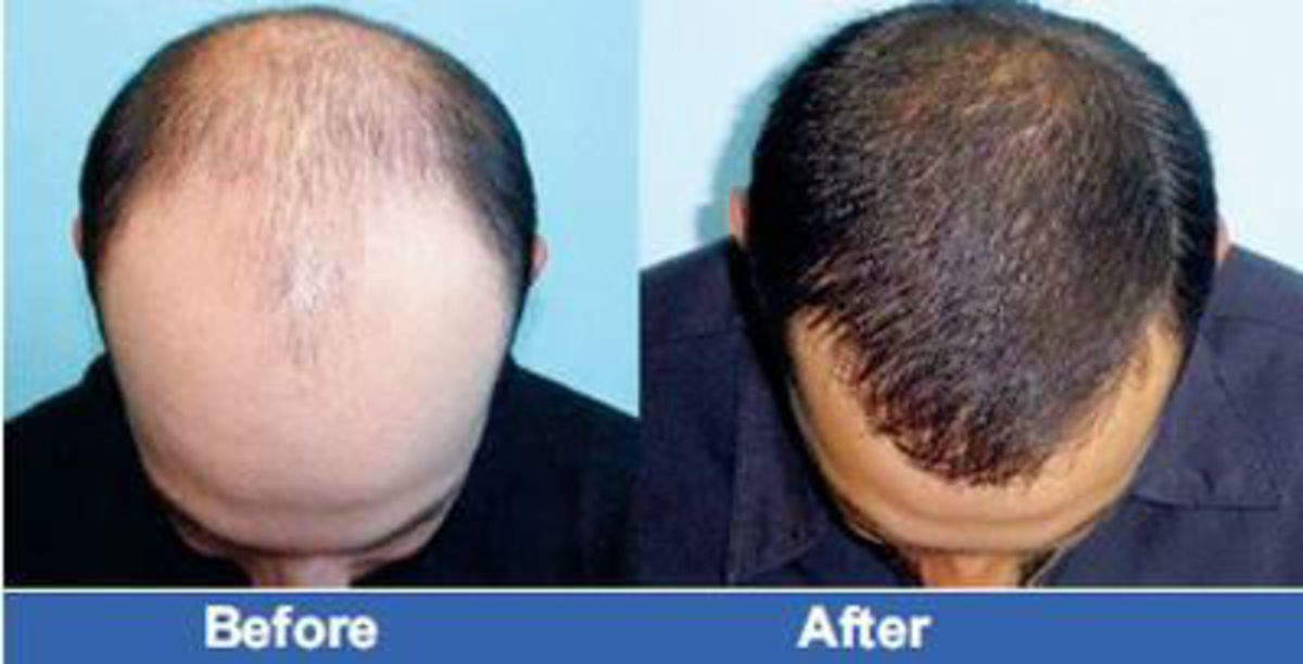 DHI tops consumer satisfaction in hair transplant services: IMRB, Retail  News, ET Retail