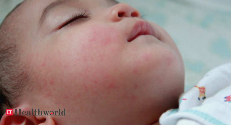 Cause of fatal disease that turns babies' lips, skin blue ...