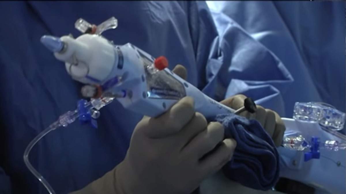 Transcatheter Mitral Valve Repair: Mitral valve repair surgery using  transcatheter technique performed at Max hospital, Health News, ET  HealthWorld
