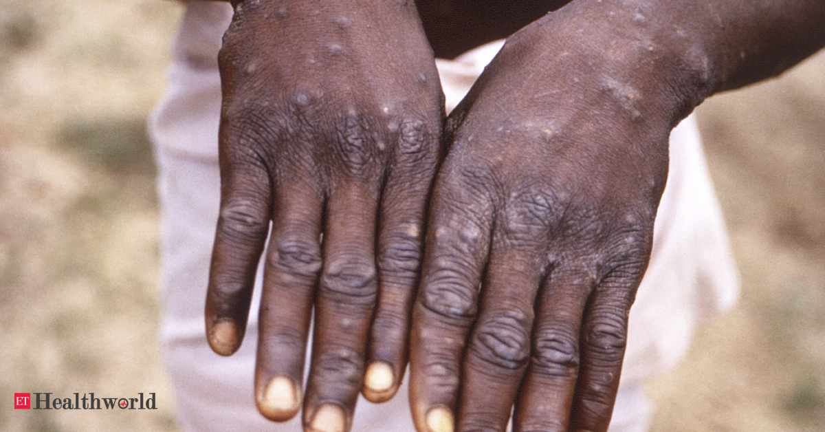 ICMR, NCDC put on alert as WHO confirms 80 monkeypox cases in 11 countries – ET HealthWorld
