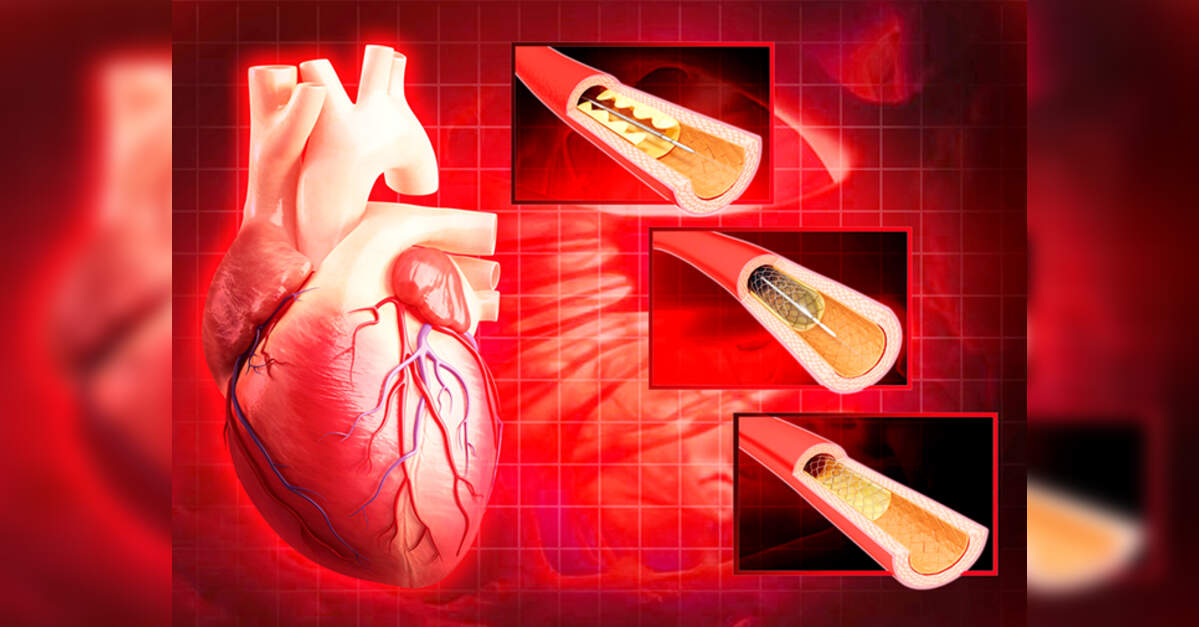 Importance of PCI (Percutaneous Coronary Intervention) optimisation in ...